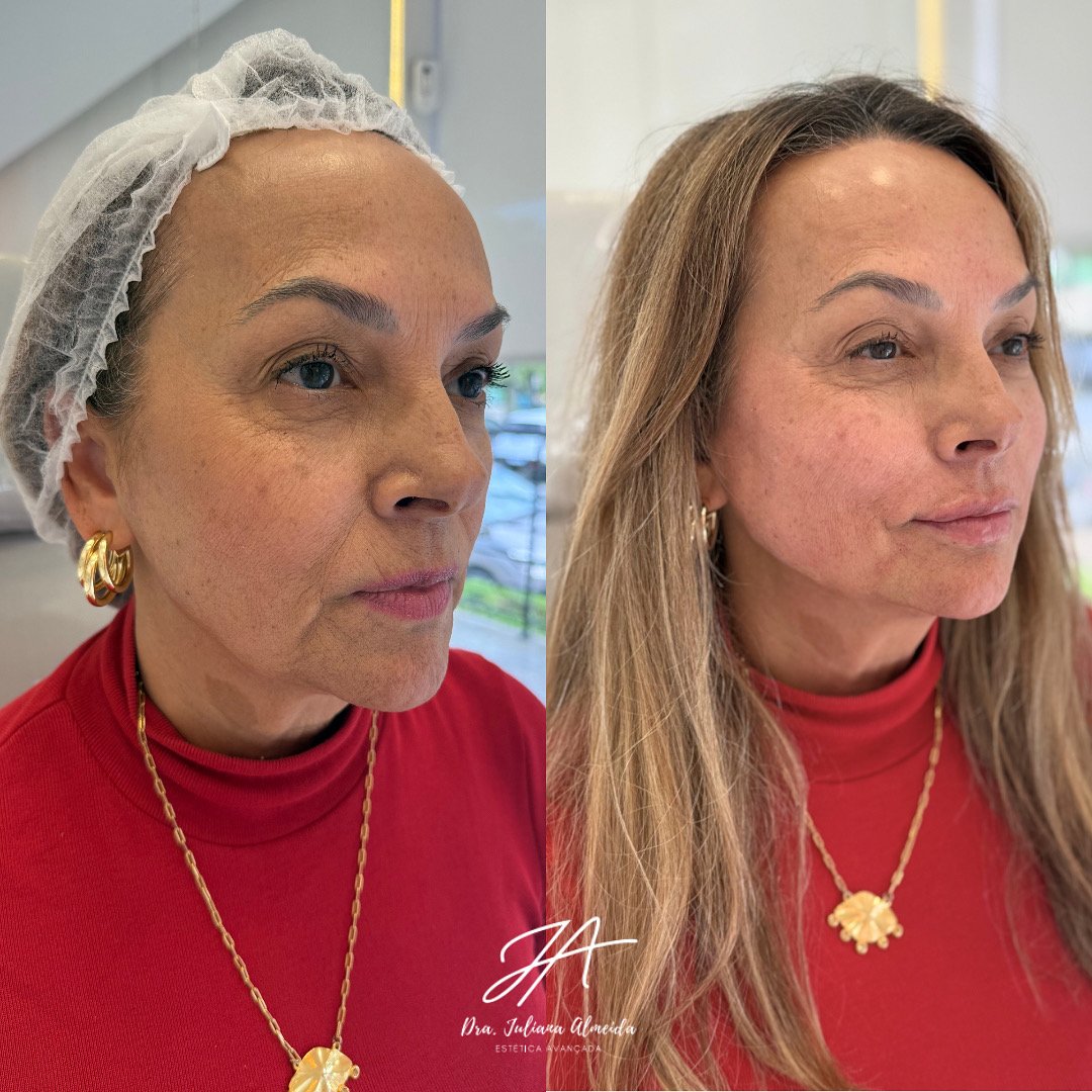 Mockup antes /depois Juliana - 1